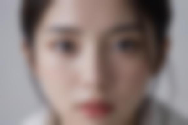 郑州张秀英医生技术好吗？管城整形科张秀英隆鼻双眼皮真实反馈！