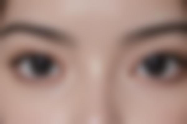 2. 毫米级精度的眼部整形