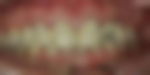 门牙做烤瓷牙套后嘴变凸是怎么回事？原因及解决办法