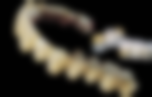 哪些因素会影响门牙烤瓷牙套的使用寿命？