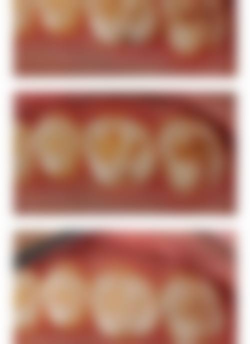 四、广州天河美云口腔美国 P60 纳米级树脂补牙项目口碑实例