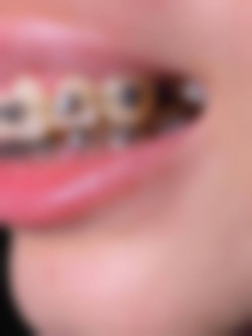 拔牙后多久适合种植牙，关键看什么