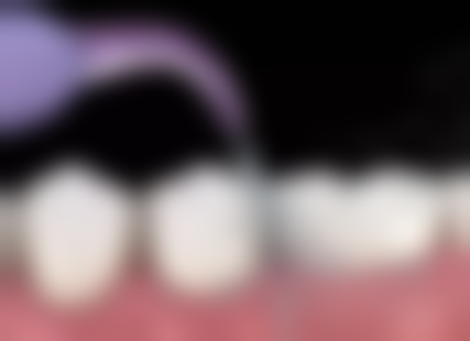 上海半口牙齿种植约4 - 8w+ ，满嘴种植牙收费会翻倍吗？