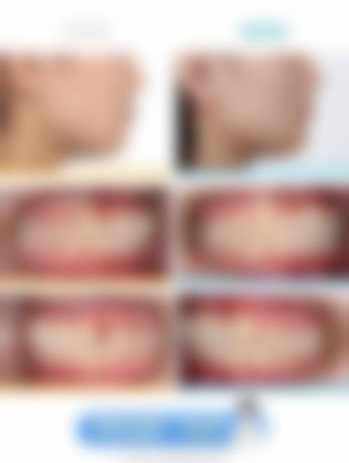 种植牙期间戴假牙常见并发症或后遗症，真实发生概率如何？