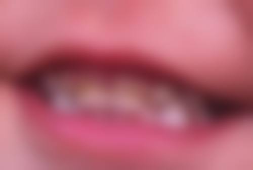 八、全口种植牙的成效稳定性取决于哪些因素？