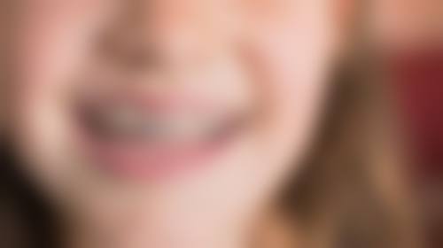 五、在实际操作中，全口种植牙更适合哪些人？