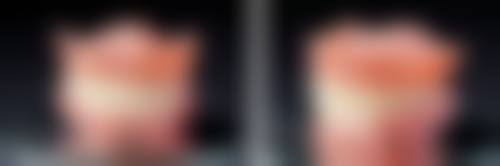 一千多的种植牙是什么？在什么情况下会被选择？