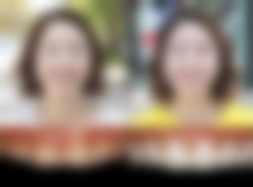 五、在实际操作中，16岁做种植牙更适合哪些人？