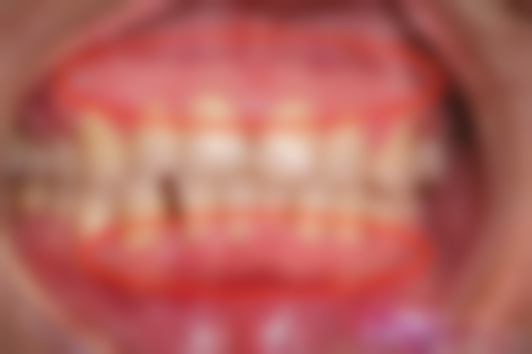 诺贝尔种植牙真实修复过程与不适时间线