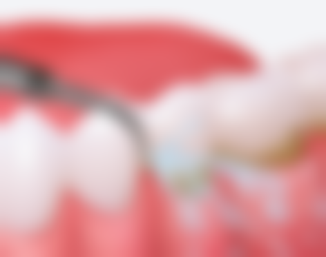 如果诺贝尔种植牙成效不理想，是否有补救与修复空间