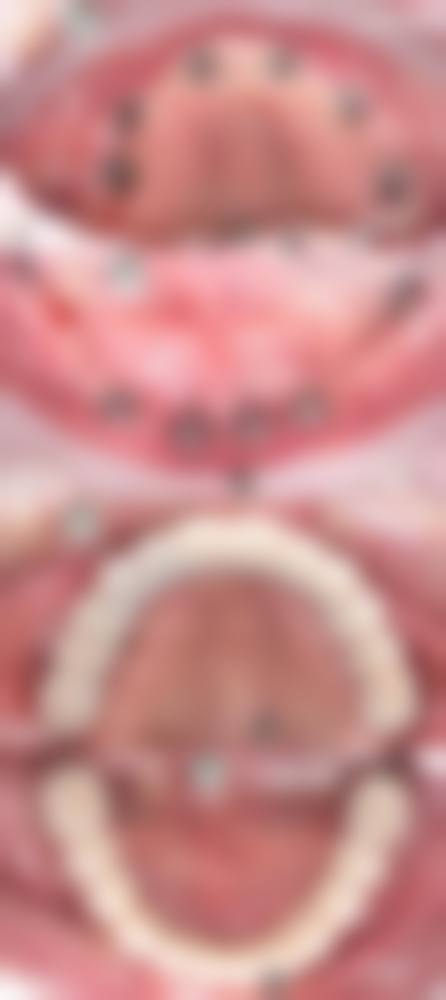 哪些情况,不太适合或需要谨慎选择种植牙?