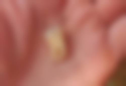 韩国登腾种植牙质量怎么样？四级纯钛打造坚实品质！