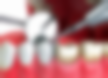 韩国登腾种植牙多少钱一颗？四级纯钛材质的性价比之选！