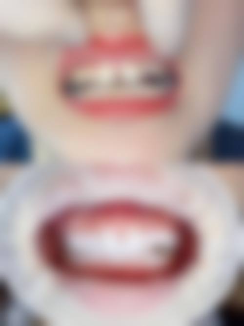 种植牙的咬合力接近真牙是真的吗