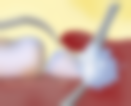 正畸支抗植入技术、各类埋伏牙牵引