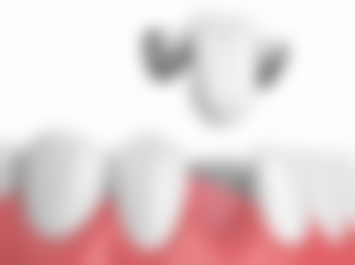 五、在实际操作中，全口种植牙种4 - 8颗更适合哪些人？