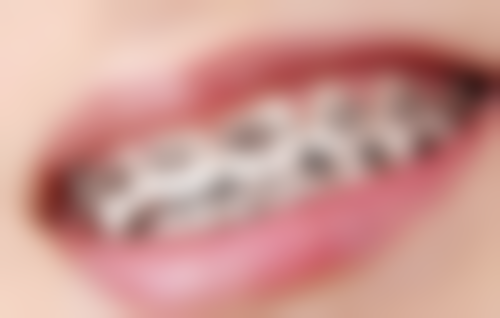 六、全口种植牙种4 - 8颗所依赖的技术 / 材料，现实优势与限制并存