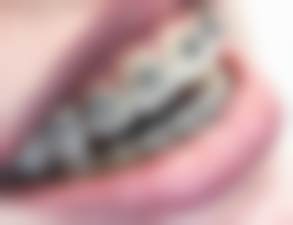 种植牙与假牙的使用舒适度