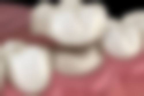 苏州全口种植牙价格的影响因素