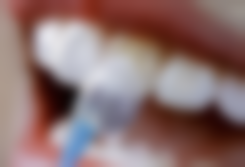 種植牙後遺症點樣處理?香港醫生建議