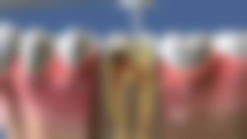 西安牙齿矫正一般价格表：2026年隐形牙套7279元起，金属矫正5100+，西安诺贝尔/小白兔/团圆口腔收费详情