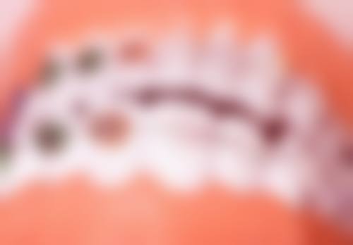 如何选择适合自己的全口种植牙方案