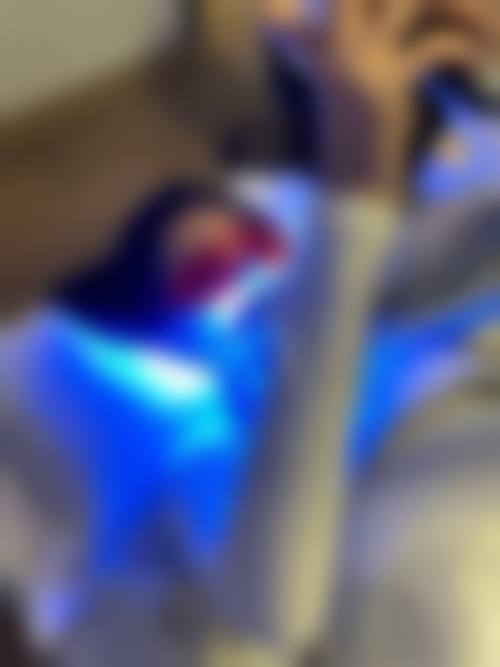 牙齿美白成效对比