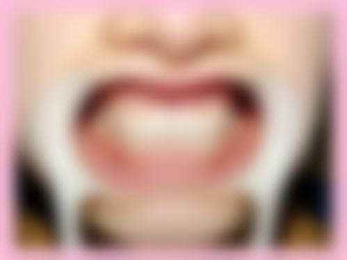 从医学角度看,种植牙牙冠的风险主要集中在哪些环节?