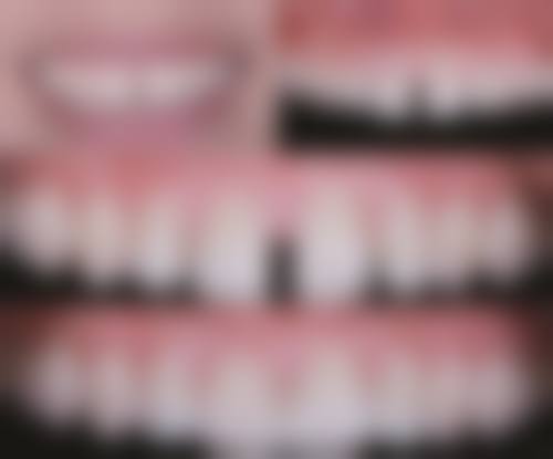 牙齿黄怎样才能变白.更简单方法