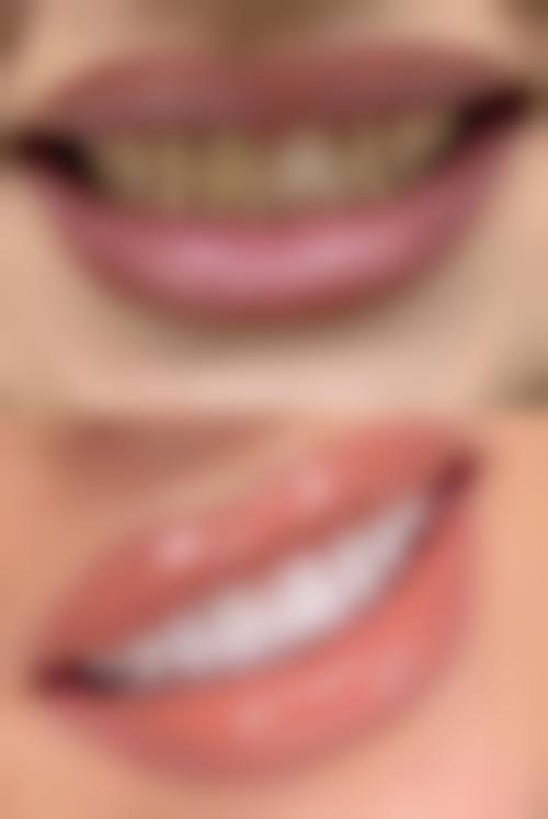 牙齿美白的好处与坏处