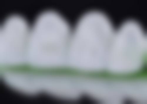 牙齿美白成效能保持多久