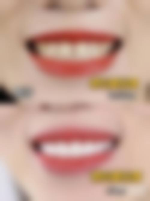 香港 澳门看牙贵吗现在 价目表大公开(2026全新)