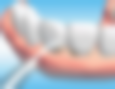 穿颧穿翼板全口种植牙价格明细