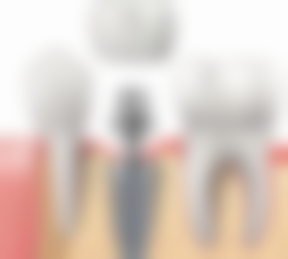 韩系All - on - 6全口种植牙价格明细