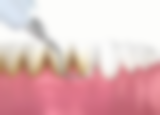 香港 種植牙危害 邊類人群風險更高?