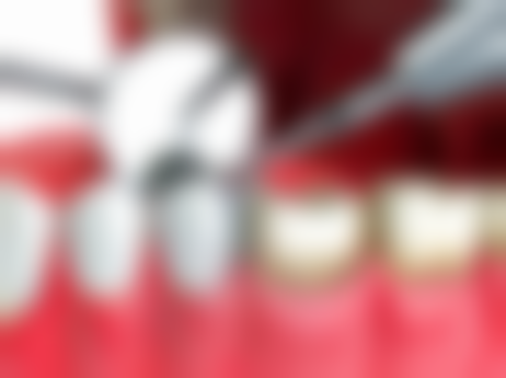 香港 種植牙危害 十大隱形風險逐個睇