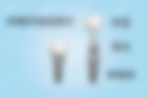 香港 大陸植牙一顆多少錢?:術前術後避坑指南