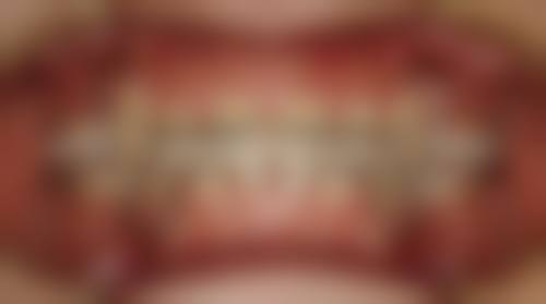 不同材质与品牌牙套的价格明细:为什么差价能差10倍?