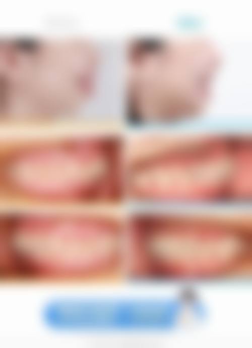 2026年苏州全口种植牙的费用揭秘：韩系全口半固定3.9万起，All-on-4技术15万起，高端定制15万起！ 