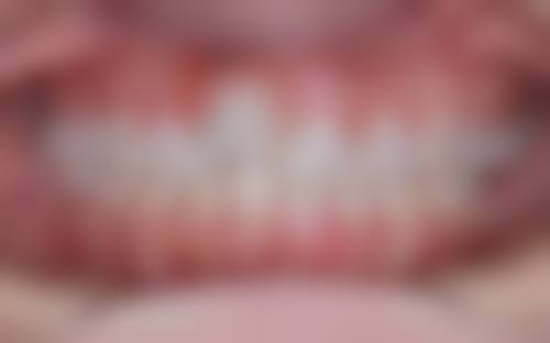 广州现在戴牙套一般多少钱?价格差异的核心影响因素