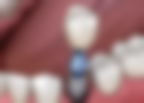 大陸植牙一顆多少錢？2026最新價格大公開！國產vs進口收費差異一文睇清