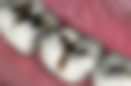 格倫菲爾口腔項目真相:香港姊妹更常問嘅3個問題