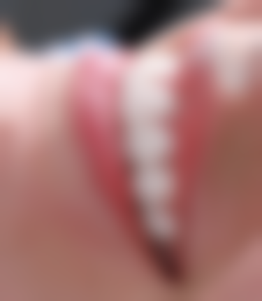 香港 種植牙過程 診所揀選要點：3步避坑指南