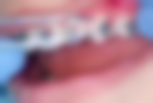 围绕骨质疏松能种植牙齿吗，临床中更常见的并发问题有哪些？