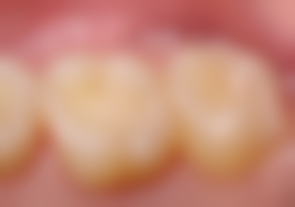 拓展延伸：香港人過深圳整牙必知3件事