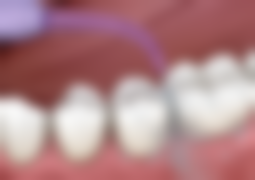 香港 珠海做根管治疗多少钱 价钱对比(HKD):香港vs珠海口岸边个抵?