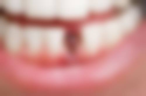 香港 澳门种植牙多少钱一个 适合边类人群？