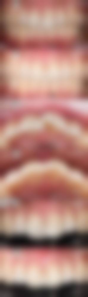 牙掉光了真的能种牙吗?费用真的在3000 - 8000元吗?