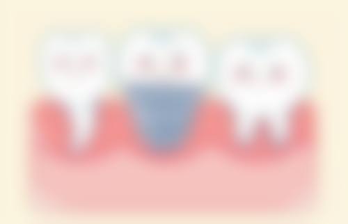 拓展延伸：深圳種牙常見Q&A + 避坑指南