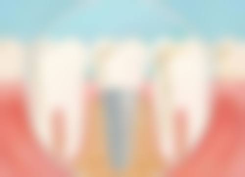 香港 大陸種牙幾多錢 適合邊類人群？睇完呢3點就知你啱唔啱